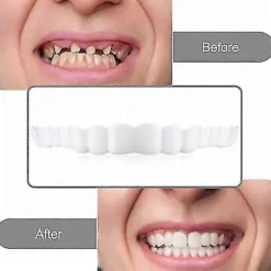 Smile Snap On Falske Tænder Øvre Nedre Dental Veneers Gebis Tanddæksel Sæt PTW