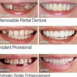 Smile Snap On Falske Tænder Øvre Nedre Dental Veneers Gebis Tanddæksel Sæt PTW