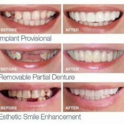 Smile Snap On Falske Tænder Øvre Nedre Dentalfiner Proteser Tanddækselsæt-m.1823 Tw